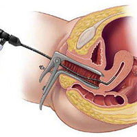Hysteroresectoscopy