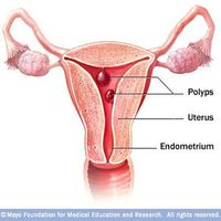 Treatment of cervical polyps in Minsk