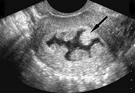 Endometrial polyps